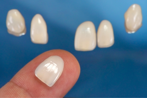 porcelain dental veneers5252