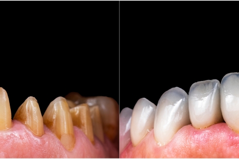 porcelain dental veneers573
