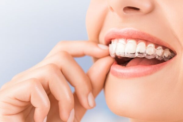invisalign-attachment-img